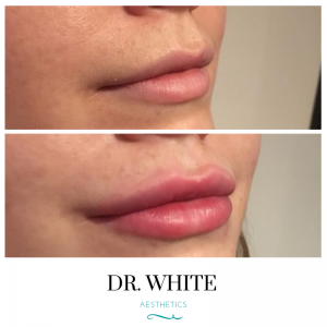 Lip Augmentation