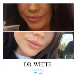 Lip Shape Correction
