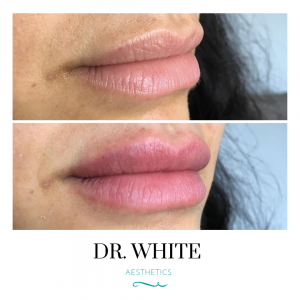 Lip Augmentation