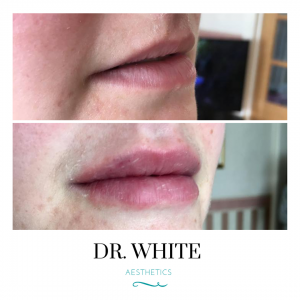 Lip Augmentation