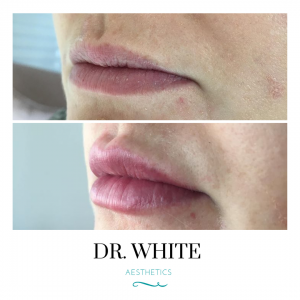 Lip Augmentation