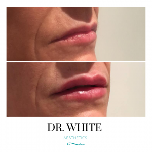 Lip Augmentation (Natural)