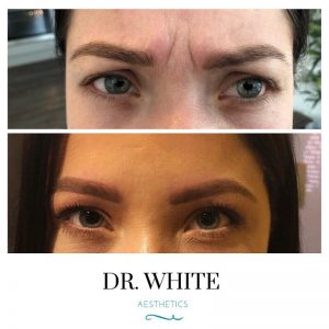 Anti-wrinkle Injections (Frown line)