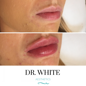Lip Augmentation