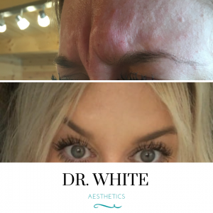 Anti-wrinkle Injections (Frown line)
