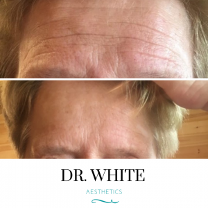 Anti-wrinkle Injections (Natural 3 area complete treatment for older client)