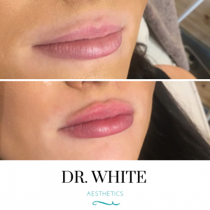 Lip Augmentation