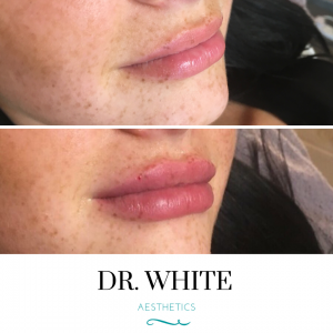 Lip Augmentation