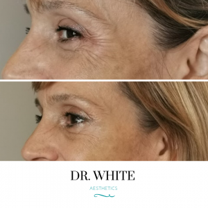 Anti-wrinkle Injections (Crow's Feet)