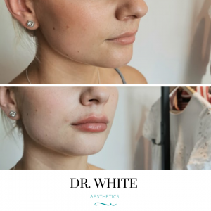 Lip Augmentation