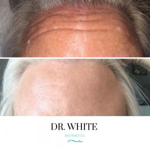 Anti-wrinkle Injections (Forehead)