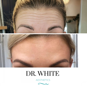 Anti-wrinkle Injections