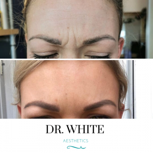 Anti-wrinkle Injections