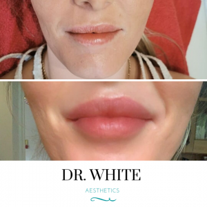 Lip Augmentation