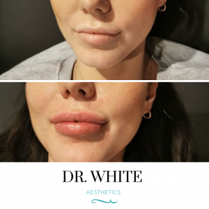 Lip Augmentation