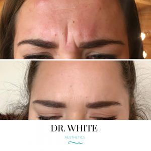 Anti-wrinkle Injections
