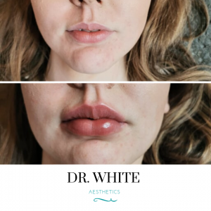 Lip Augmentation
