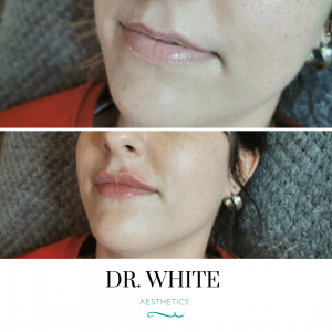 Lip Augmentation