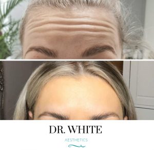 Anti-wrinkle Injections