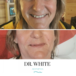 Nasolabial Folds - Dermal Filler