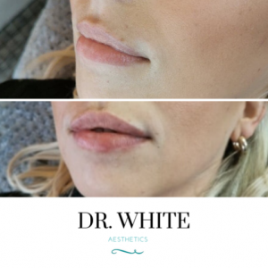 Lip Augmentation